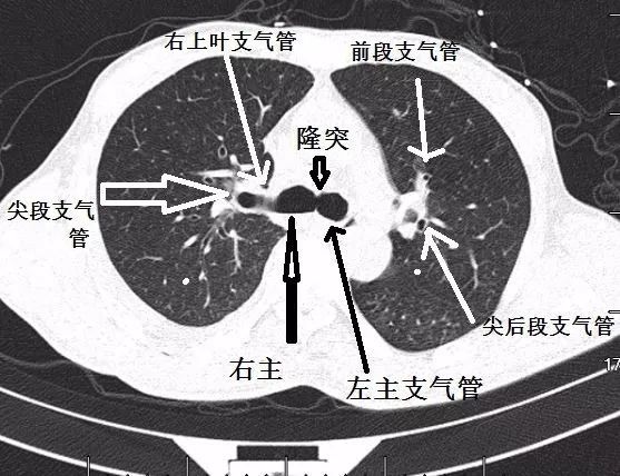 支气管ct解剖最佳学习资料|图谱 视频解说