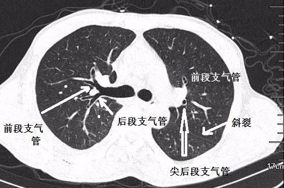 支气管ct解剖最佳学习资料|图谱 视频解说