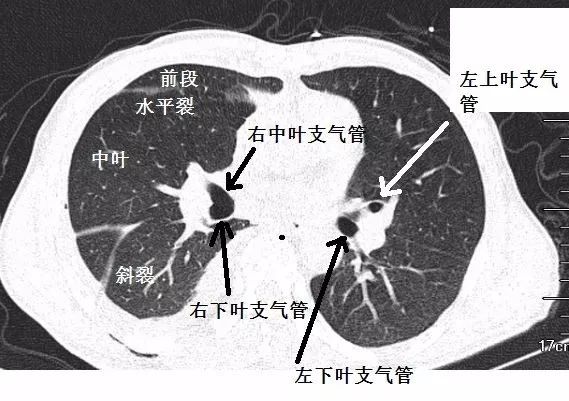 支气管ct解剖最佳学习资料|图谱 视频解说