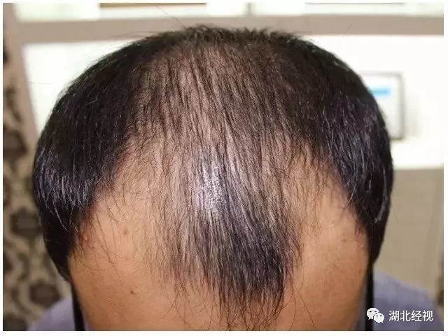 术后19天 受脱发困扰5,6年了,头发爱出油,两侧额角大面积缺发,头顶