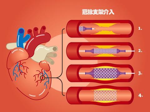 心脏支架术后能运动吗?该如何运动?需要注意些什么?