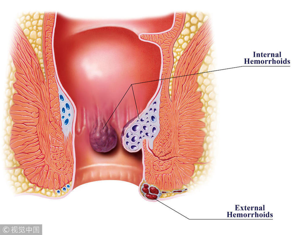 痔疮但肛周疖肿,却与痔疮不同,它也是长在臀部的炎症包块,也是细菌
