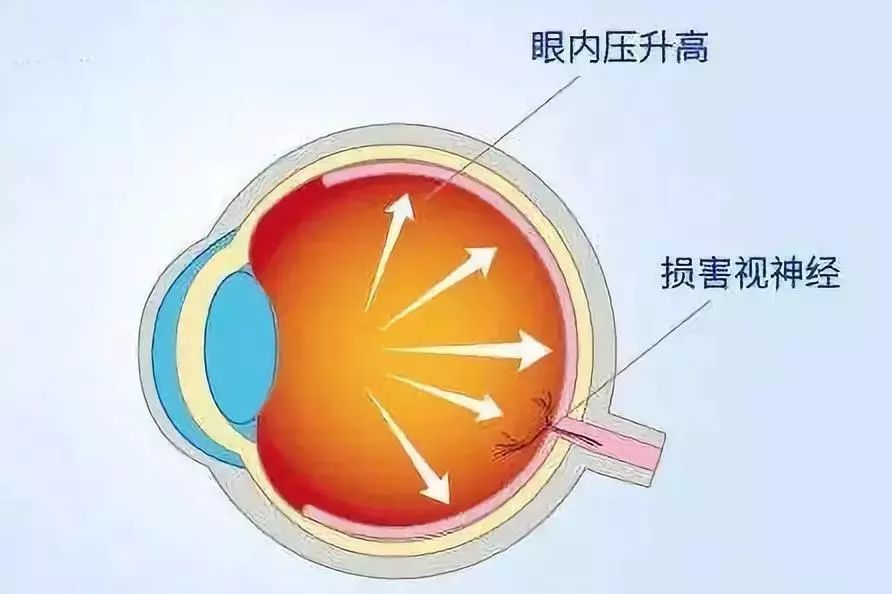 眼压为什么会异常升高呢?