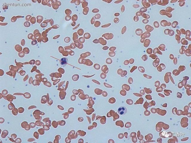 人体血液中的镰状细胞:存在正常的红细胞和镰状细胞.