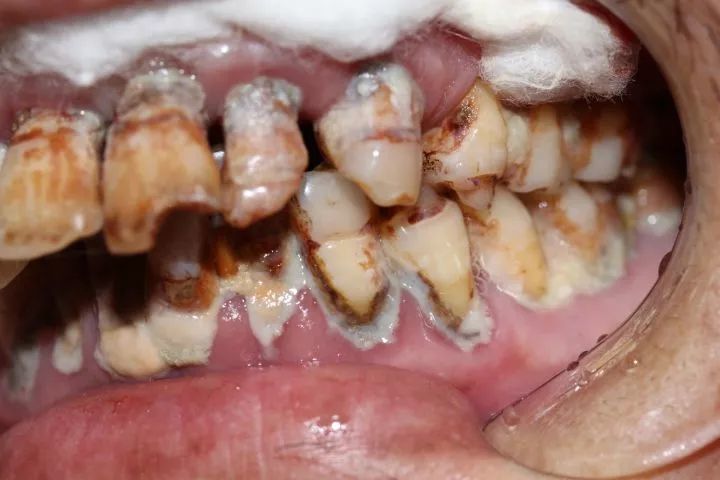 牙医碰见最烂的牙齿到底有多烂?
