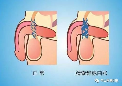 据他自己回忆,最近几年,他的左侧阴囊比右侧稍微大一些,有点下垂,表面