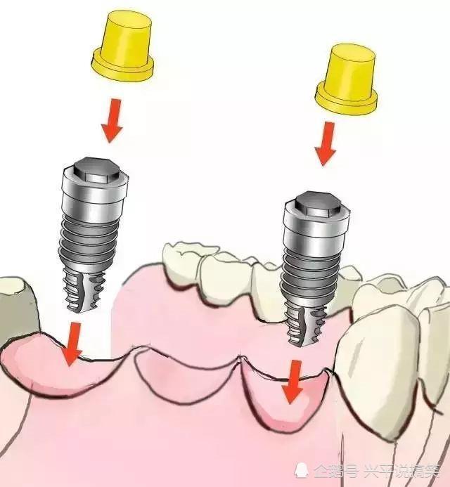 图解"种植牙"把缺失的"幸福"种回来,一次种植终身收益