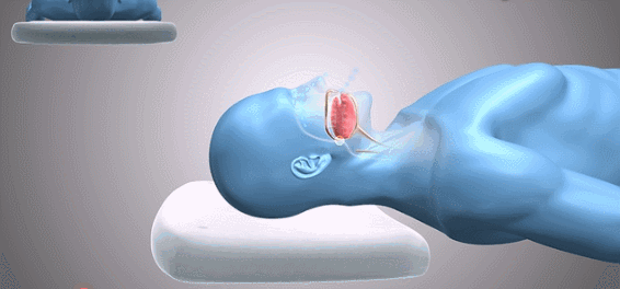 打呼噜原理模拟图    "阻塞性睡眠呼吸暂停低通气综合 征" ,是