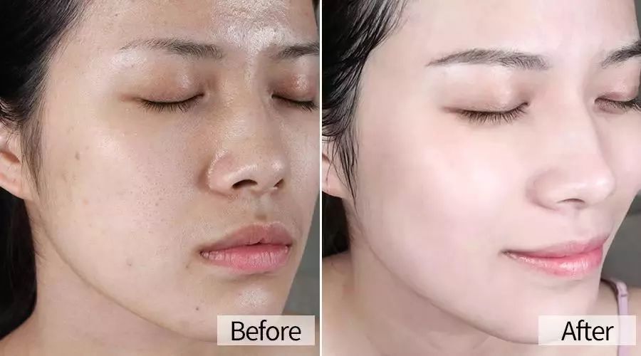 原本脸部毛孔粗糙,皮肤暗沉,使用后 毛孔细腻,脸上白了不止一个度
