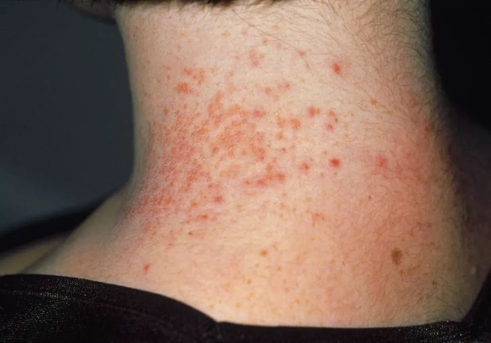 皮炎和湿疹都有红斑,丘疹,丘疱疹,可两种皮肤病的区别