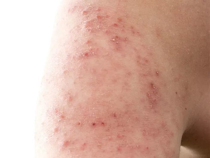 皮炎和湿疹都有红斑,丘疹,丘疱疹,可两种皮肤病的区别
