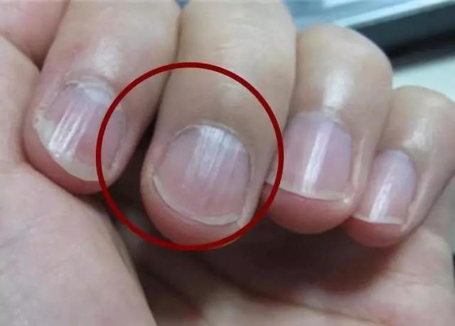 养生专家注意了:指甲有很多竖纹?可能是3种疾病的暗示