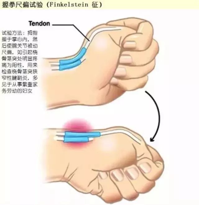四根手指握住大拇指,手腕向小指方向折叠,如果疼痛就说明可能有腱鞘炎