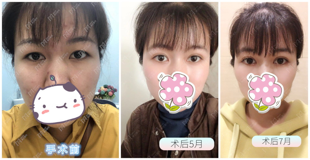 肿眼泡形成的原因和分类,看看有没