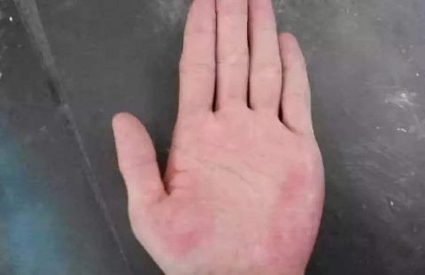 手上出现4个症状,肝可能不好|指甲|肝脏|肝病|肝掌|肝硬化
