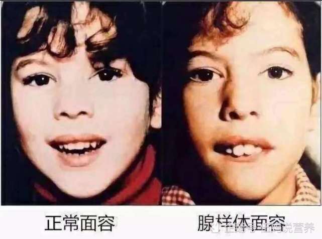 孩子睡觉张口呼吸越长越丑,原来腺样体肥大,营养师说