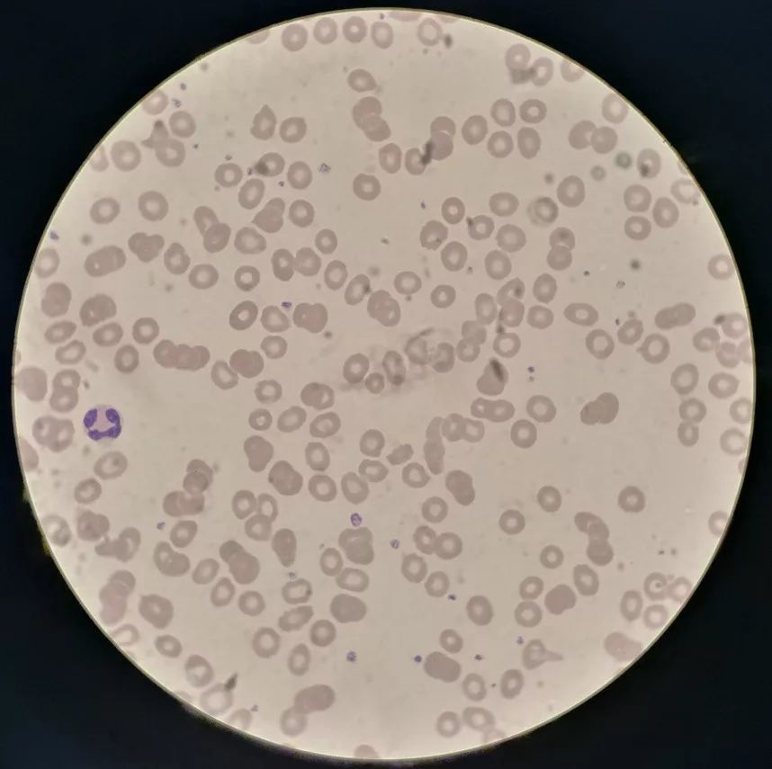 不同血红蛋白含量的红细胞显微镜下形态学观察