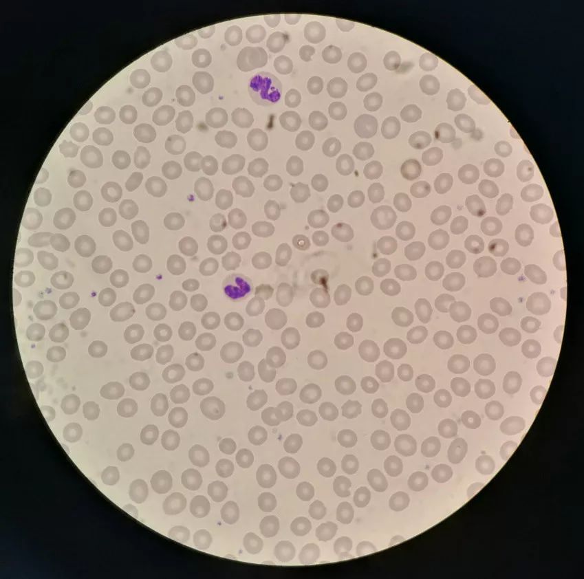 不同血红蛋白含量的红细胞显微镜下形态学观察