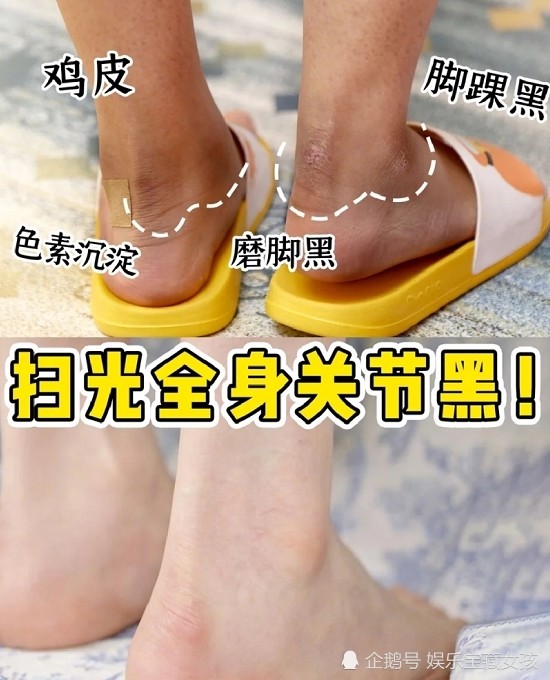 日本美白简单法 脚腕黑关节黑天生黑 黑鸡皮蜕变白秘方超管用 看点快报