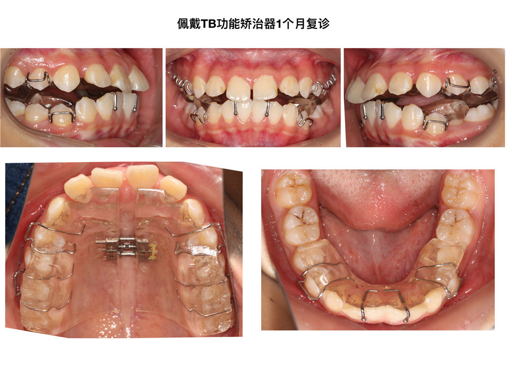 上颌前突下颌后缩一期功能矫治改善面型