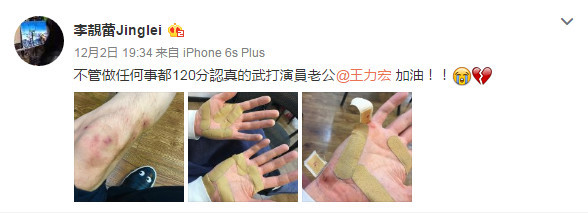 膝盖淤青双手缠满胶布 王力宏受伤老婆好心疼