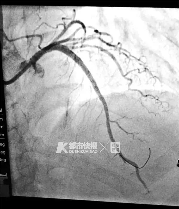 病人心脏前降支近段100%堵塞