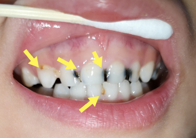 一组图告诉你,孩子的牙齿是怎么一步步被"虫子"吃掉的