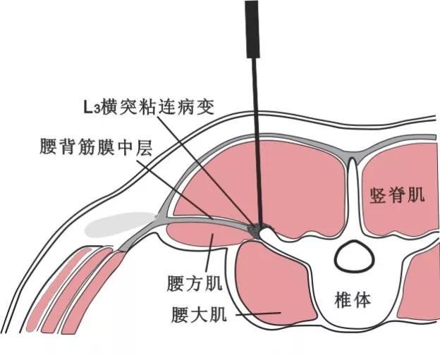 腰三横突你真的扎对了吗?