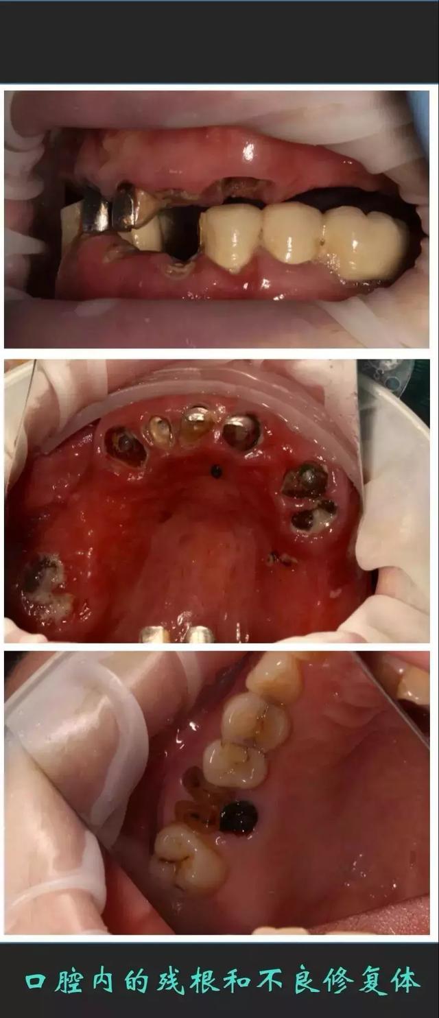 经常牙龈出血,牙疼,口臭的人要当心,这可能会引发癌变