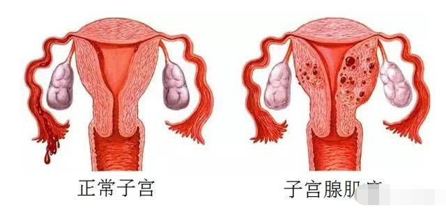 子宫腺肌症是什么引起的?真相被揭开,让人不敢相信!