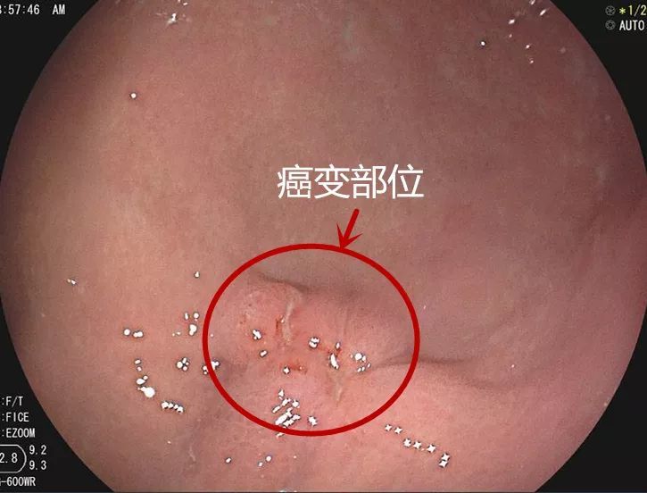 胃癌早期无明显症状,检出率低