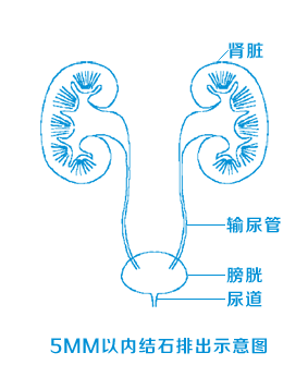 得了输尿管结石不用怕,疼痛不要忍,这样治疗就可以啦!