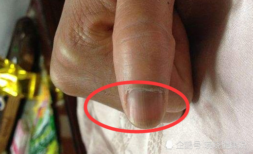 手指甲发黑图片竖纹_艺图网