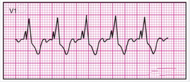 【干货收藏】14种异常心电图的波形特点