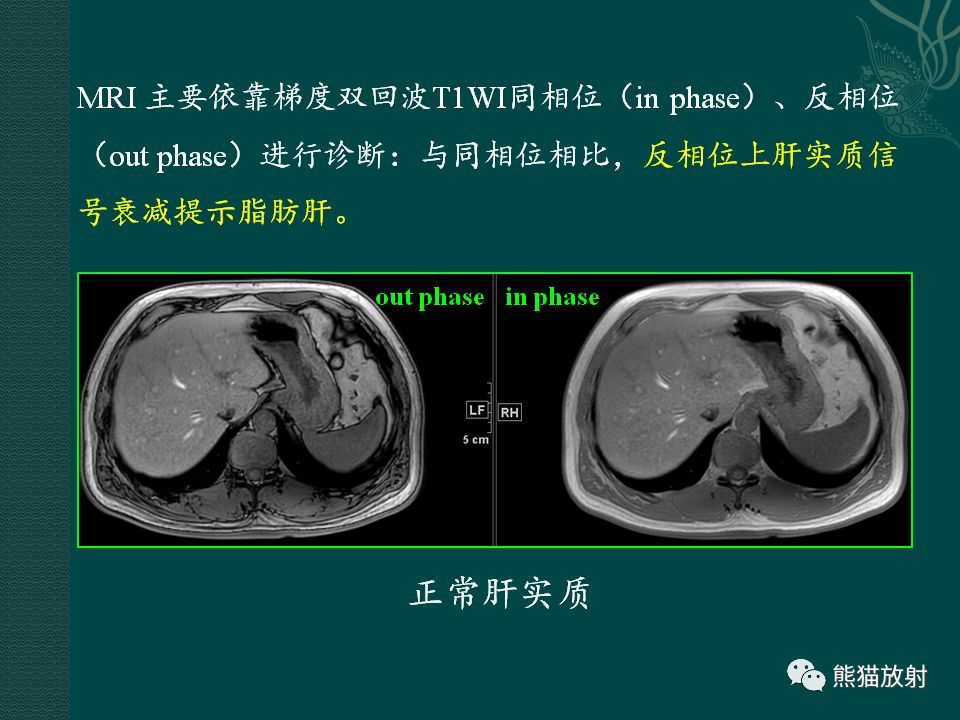 肝脏常见病变丨ct及mri诊断