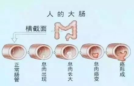 3,炎症性肠病