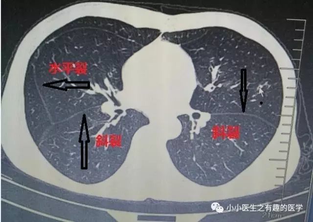 手把手教你轻松掌握肺段分布及重要血管