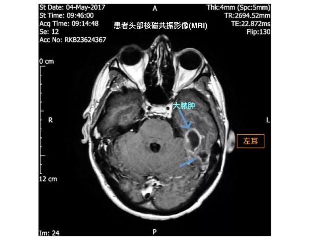 患者的mri图丨来源:论文1