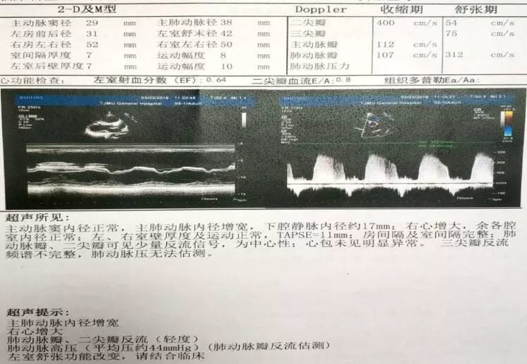 超声心动图(1年前):右心增大,主肺动脉增宽,肺动脉高压(平均肺