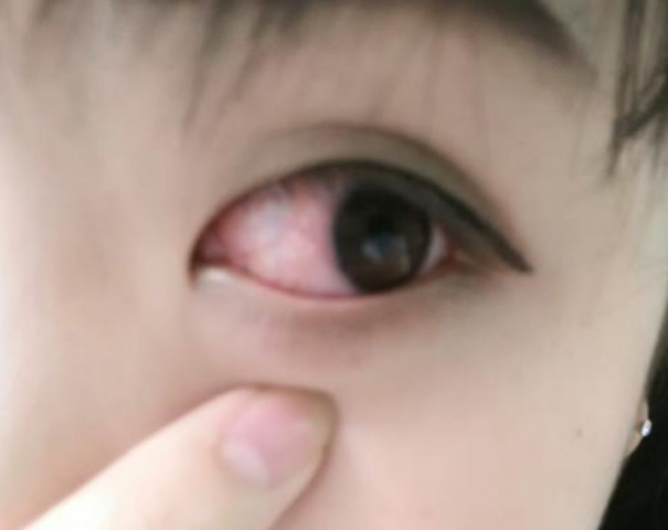 肝癌来临前,眼睛有2个"信号",专家:乙肝患者最好检查