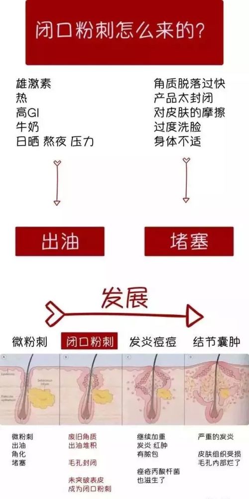 美丽讲堂开口闭口粉刺识别黑头白头了解这些你冒痘的脸还有得救