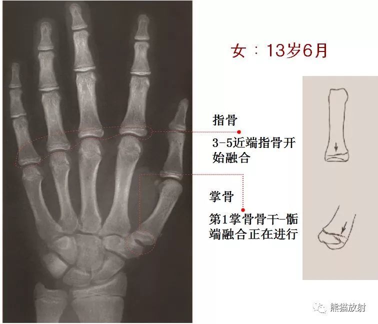 延迟:骨龄比生活年龄小1岁以上; 正常:骨龄与生活年龄相差不超过1岁.