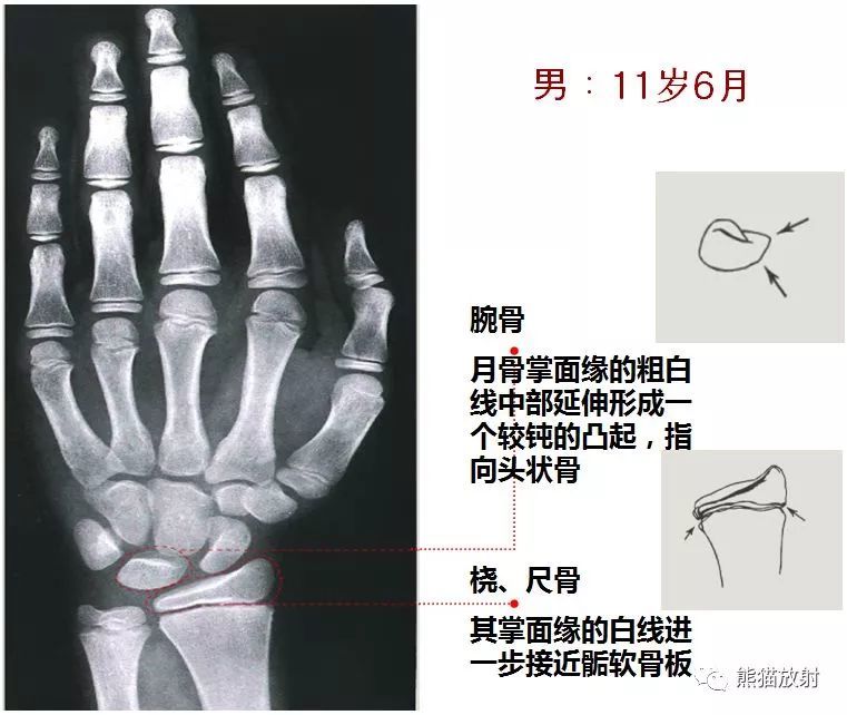 延迟:骨龄比生活年龄小1岁以上; 正常:骨龄与生活年龄相差不超过1岁.