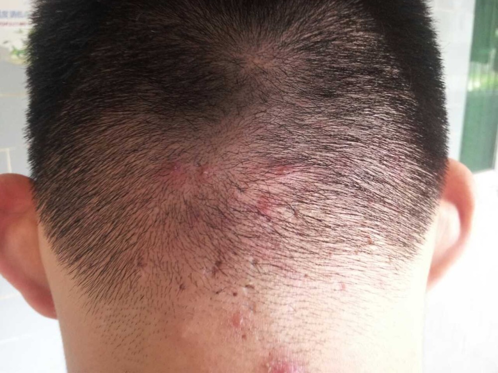00后经常做的几个习惯,一定要改掉,不然头皮"爆痘"又心烦