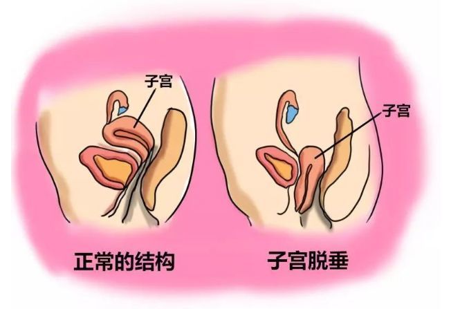 很多人觉得,老一辈因为生完孩子不注意,就去干粗重活了,所以才会子宫