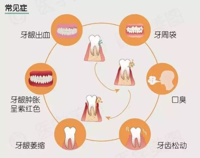 当心牙周炎!