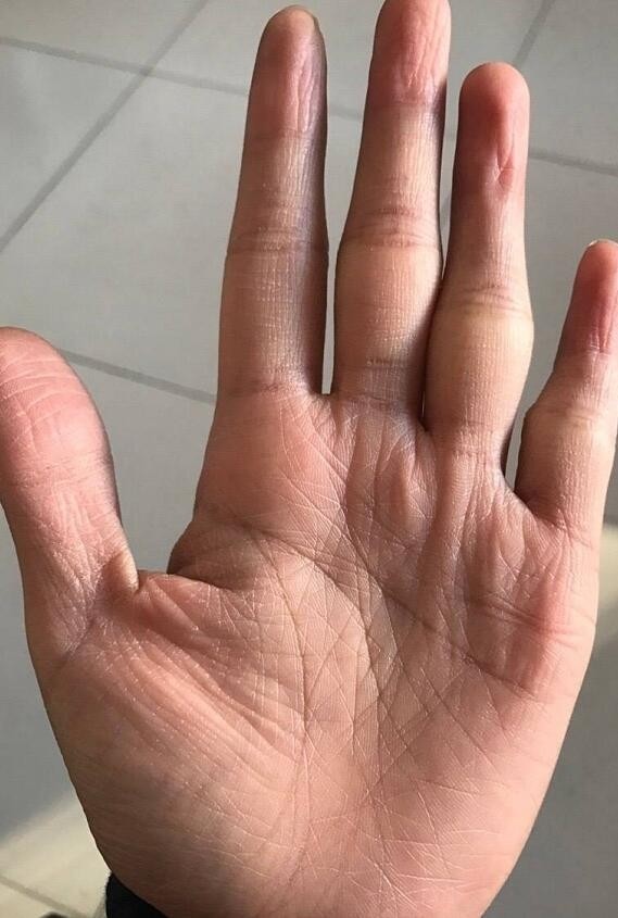 天纹是副事业线～～如果天纹后半截有岛纹的,中年以后事业比较辛劳,多
