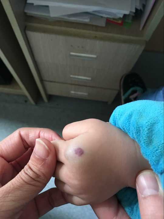 孕期如何预防宝宝得血管瘤
