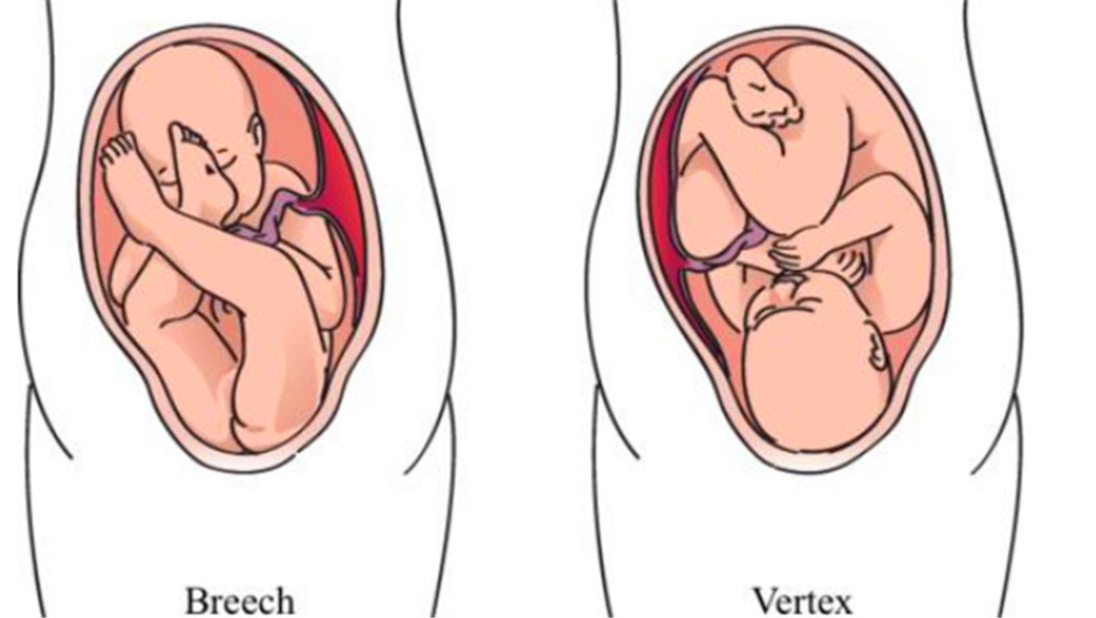 孕后期宝宝一直处于臀位状态,那么臀位宝宝生出来腿会