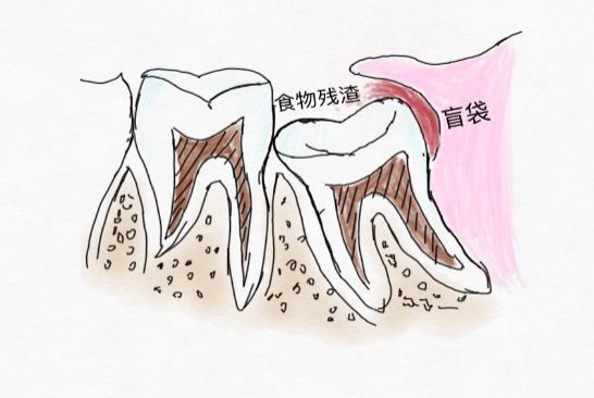 导致智齿冠周炎.